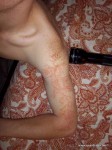 Gear Diary Meet Winston Kemp, Lightning Strike Survivor and Lichtenberg Figure Owner photo