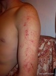 Gear Diary Meet Winston Kemp, Lightning Strike Survivor and Lichtenberg Figure Owner photo