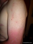 Gear Diary Meet Winston Kemp, Lightning Strike Survivor and Lichtenberg Figure Owner photo